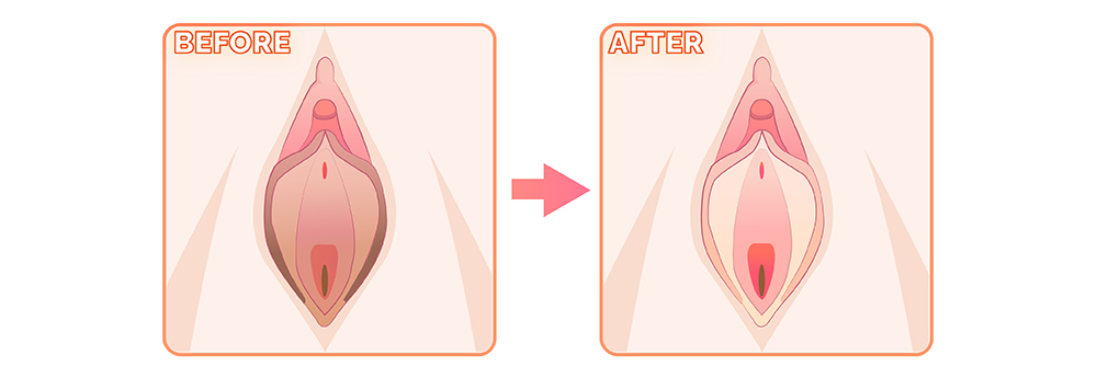私密處陰唇美白手術台中權威醫師推薦