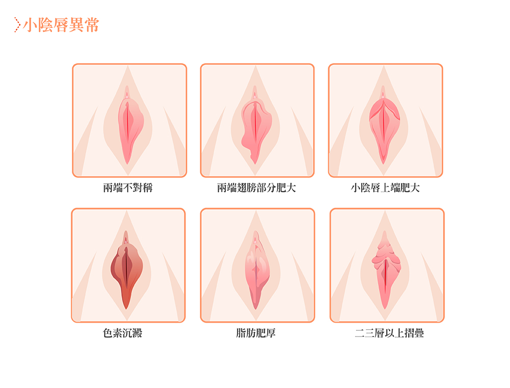 台中縮修陰唇整形手術權威女醫師004