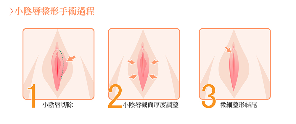 台中縮修陰唇整形手術權威女醫師005