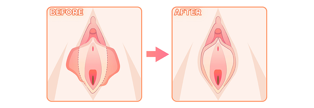 台中縮修陰唇整形手術權威女醫師006