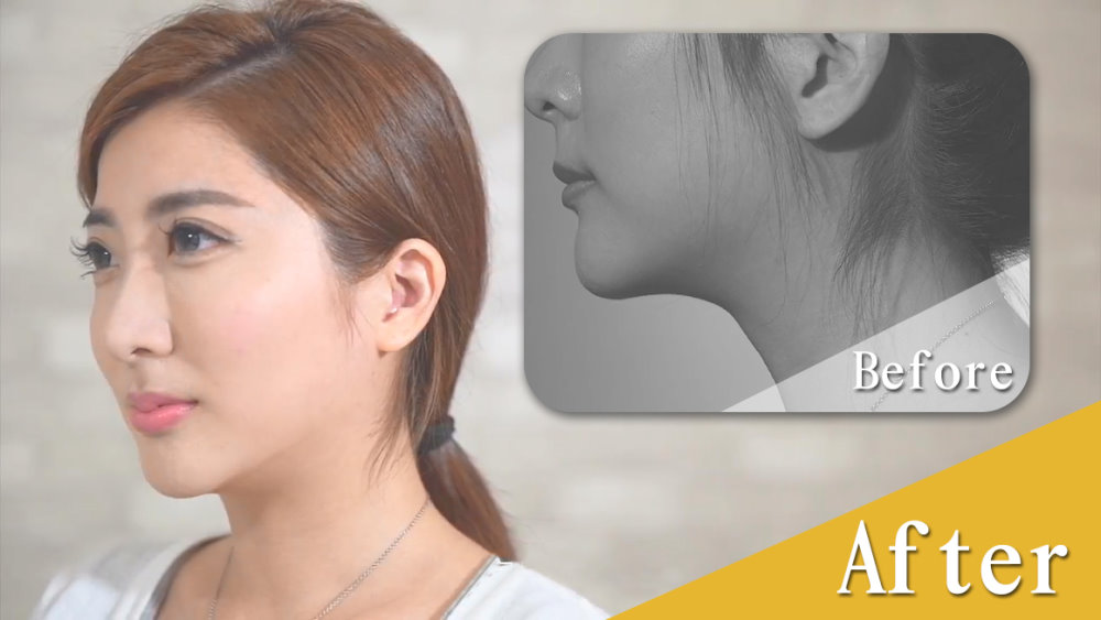 台中臉部埋線拉提拉皮案例009