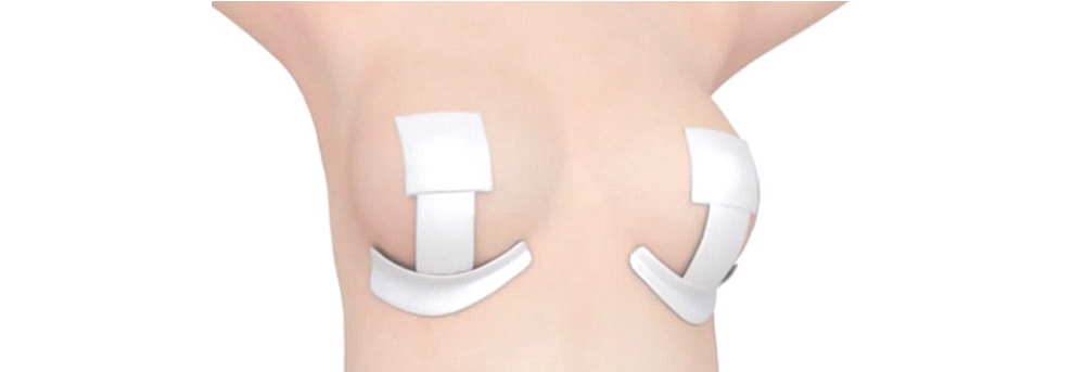 平胸手術注意事項