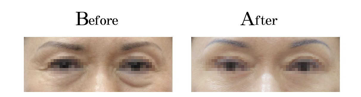 眼袋外開手術案例1 - 台中教主醫美