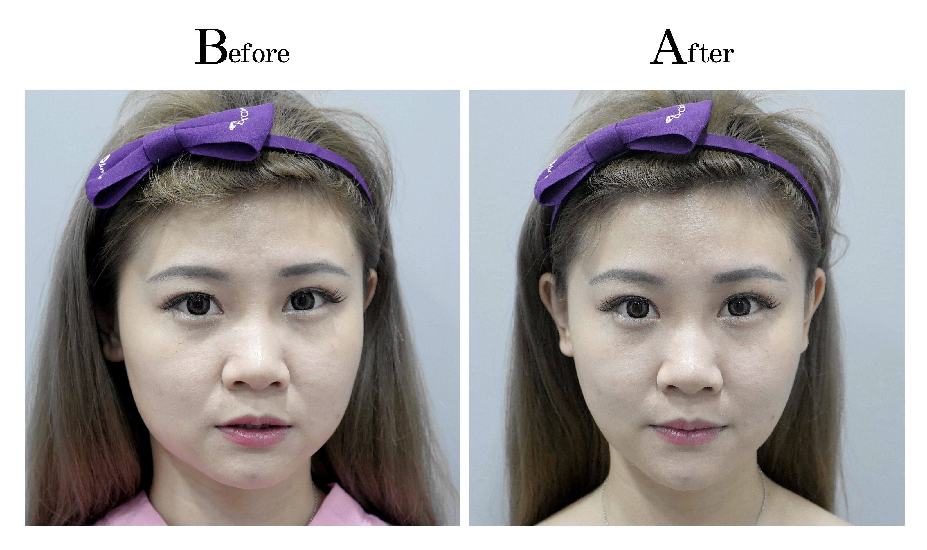 台中臉部埋線拉提拉皮案例003