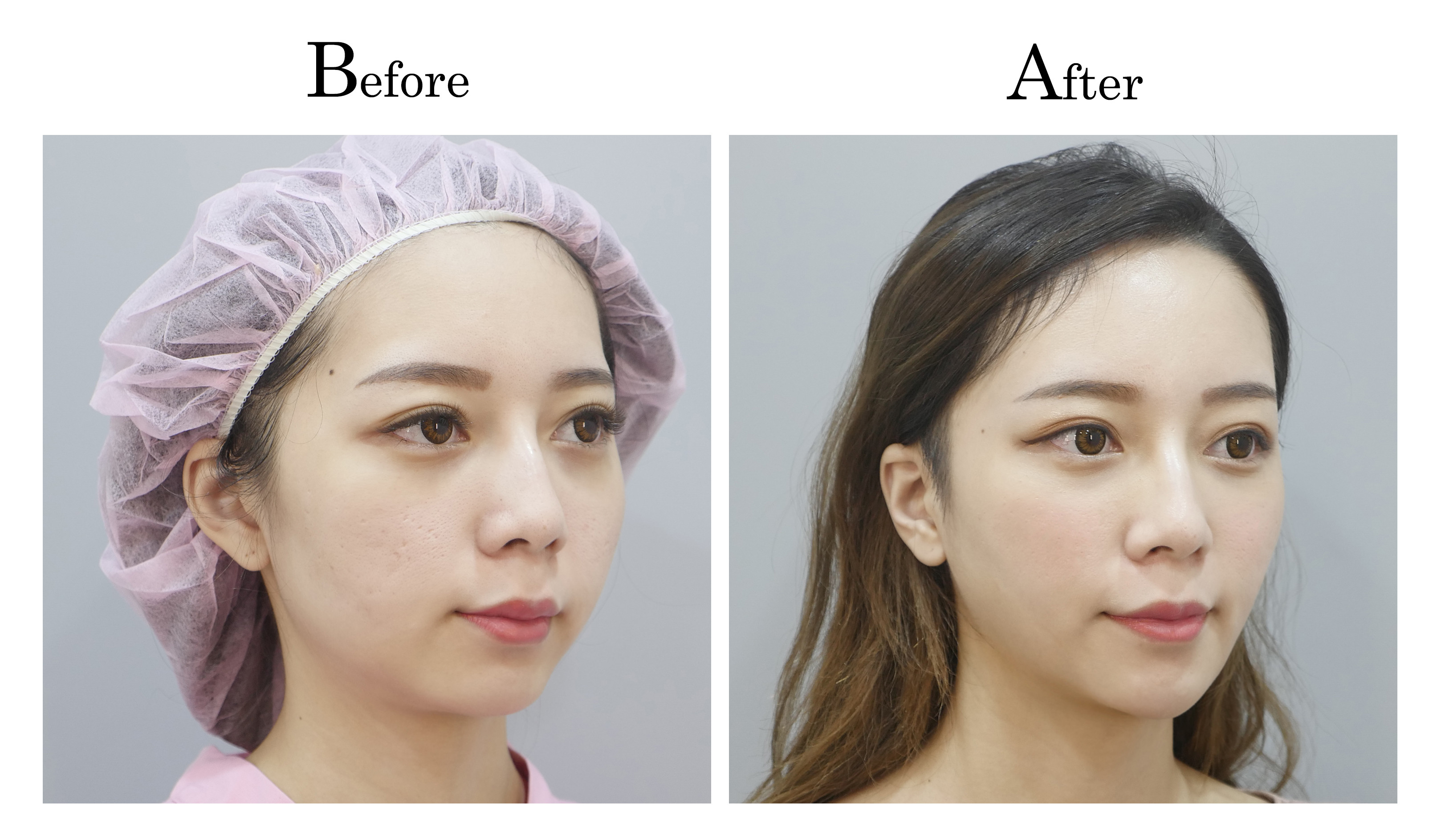 台中臉部埋線拉提拉皮案例002