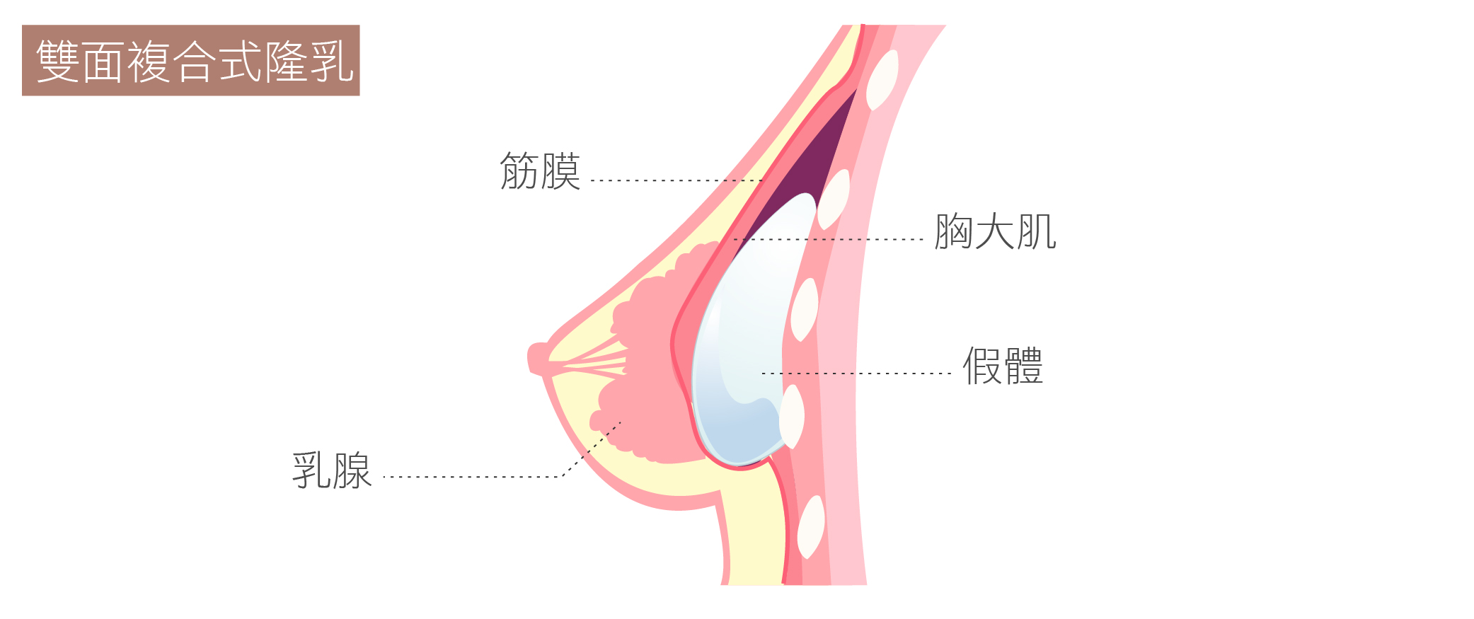 台中隆乳分期付款