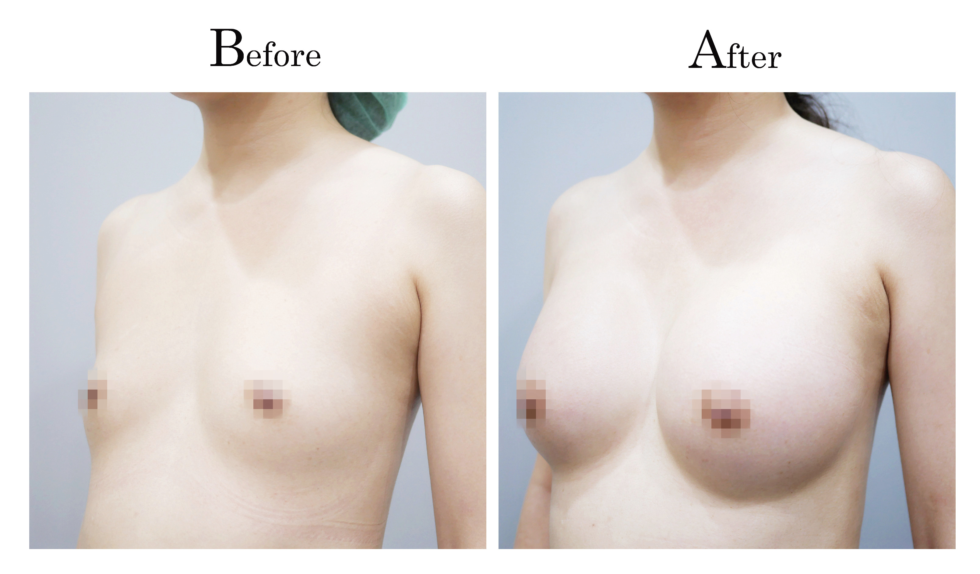 魔滴隆乳權威推薦台中