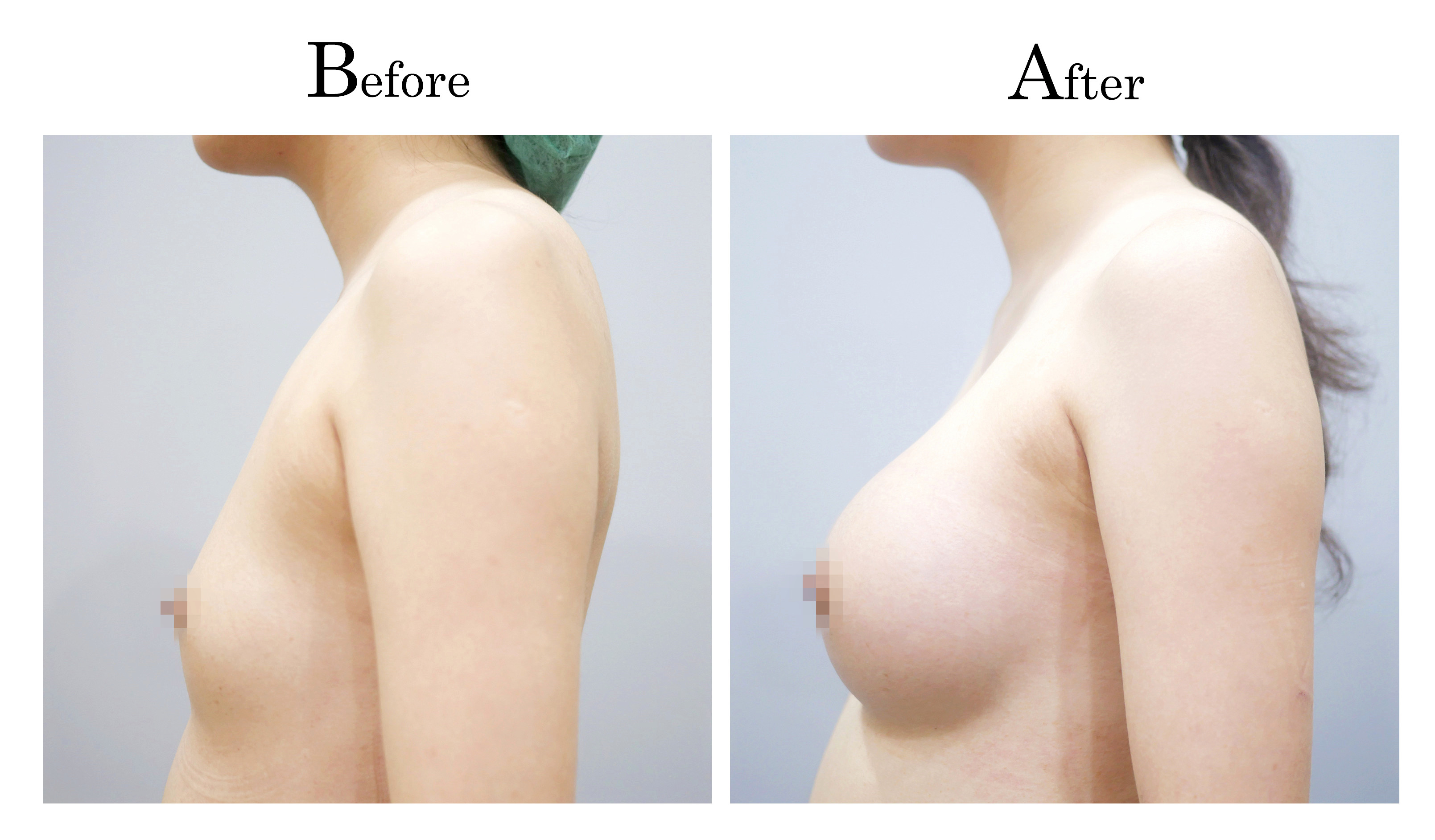 隆乳魔滴Motiva,台中魔滴胸