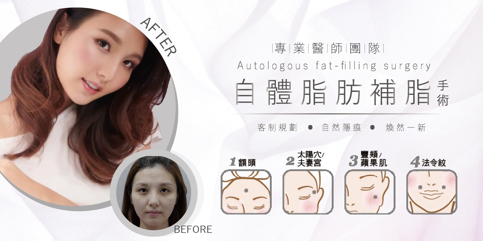 自體脂肪補臉手術案例