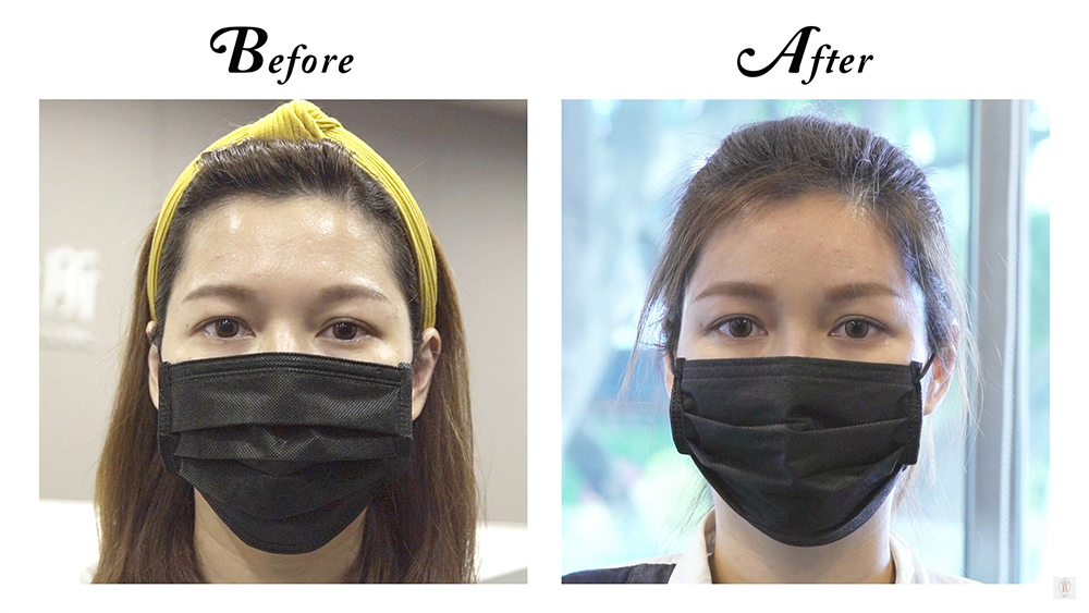 自體脂肪補臉手術案例