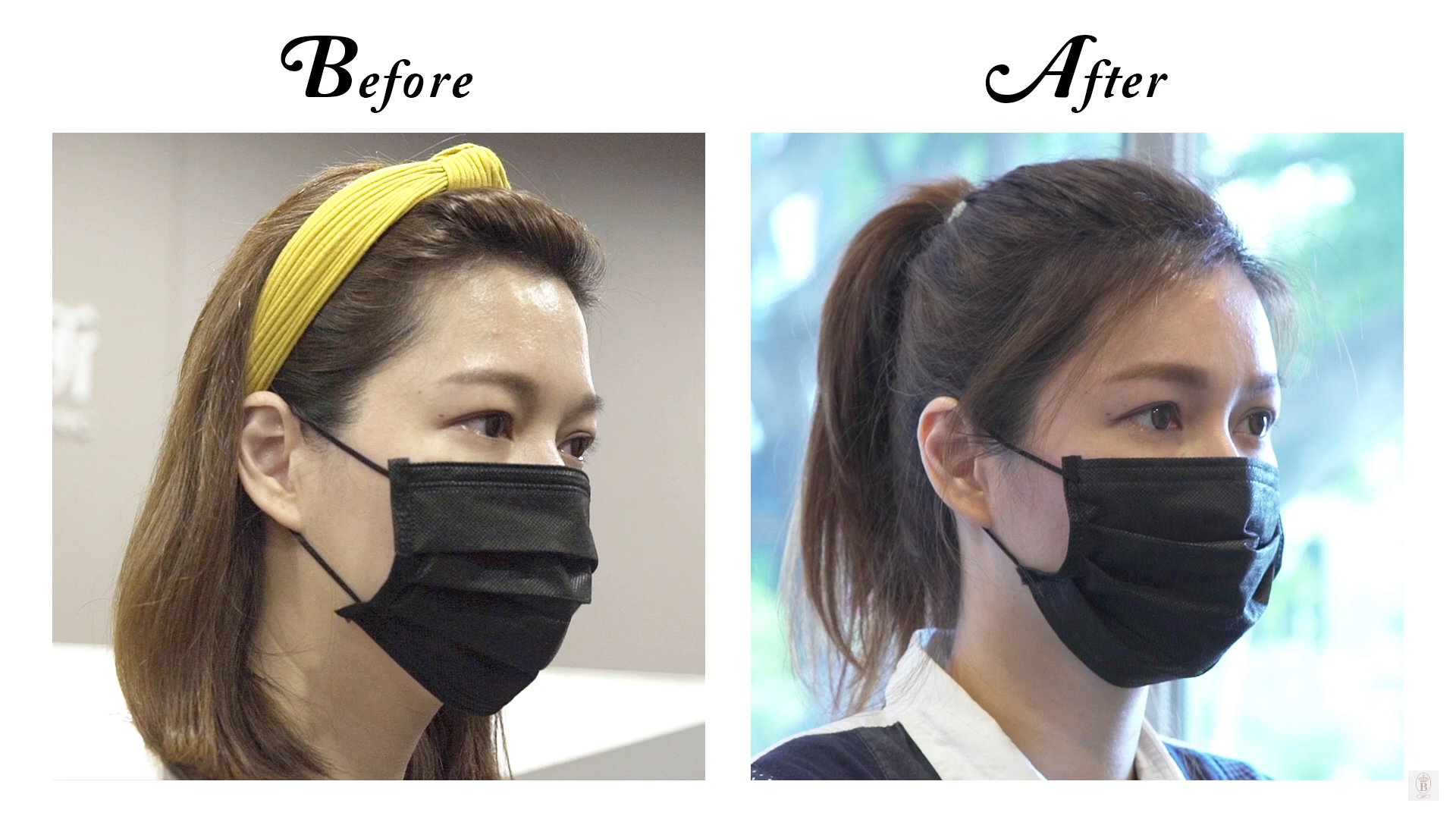 自體脂肪補臉手術案例