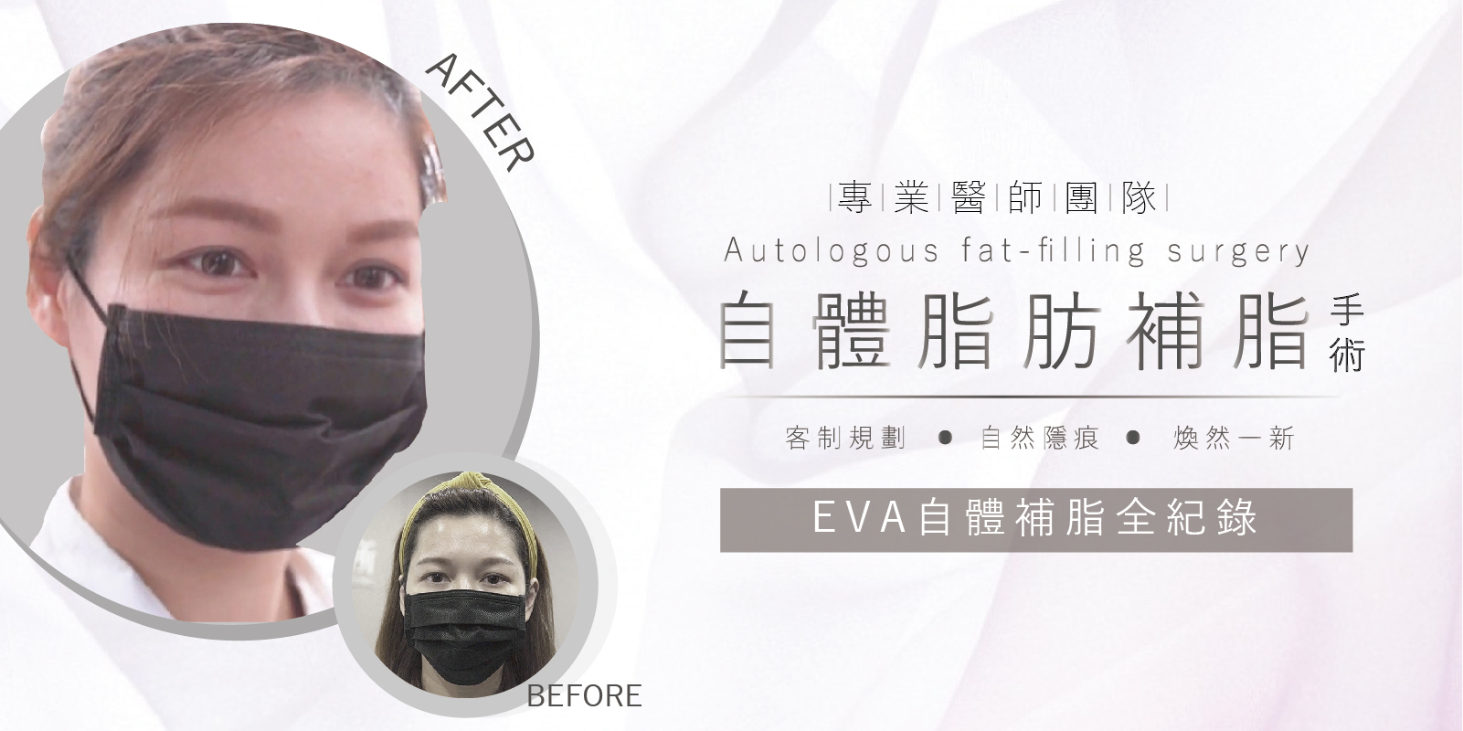 自體脂肪補臉手術案例