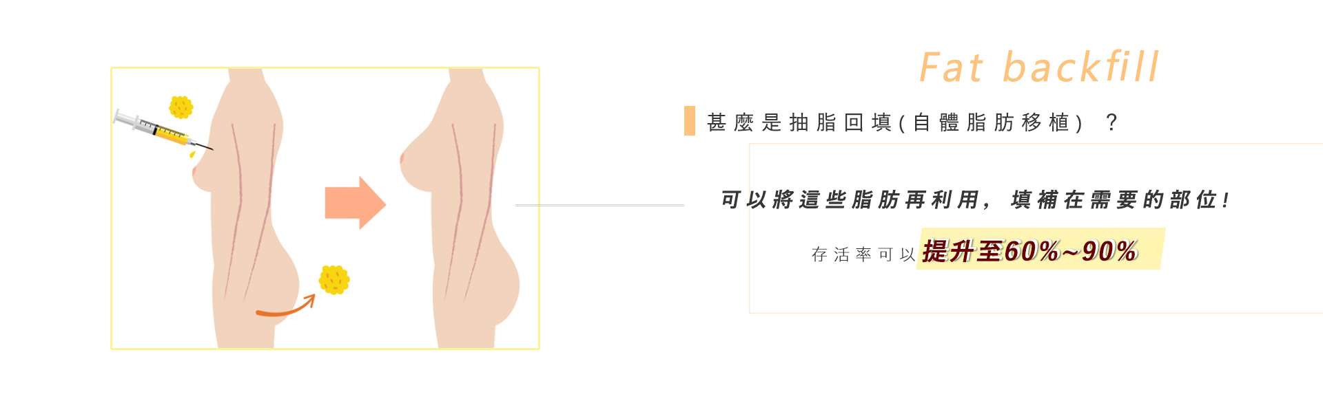 甚麼是抽脂回填(自體脂肪移植) ?