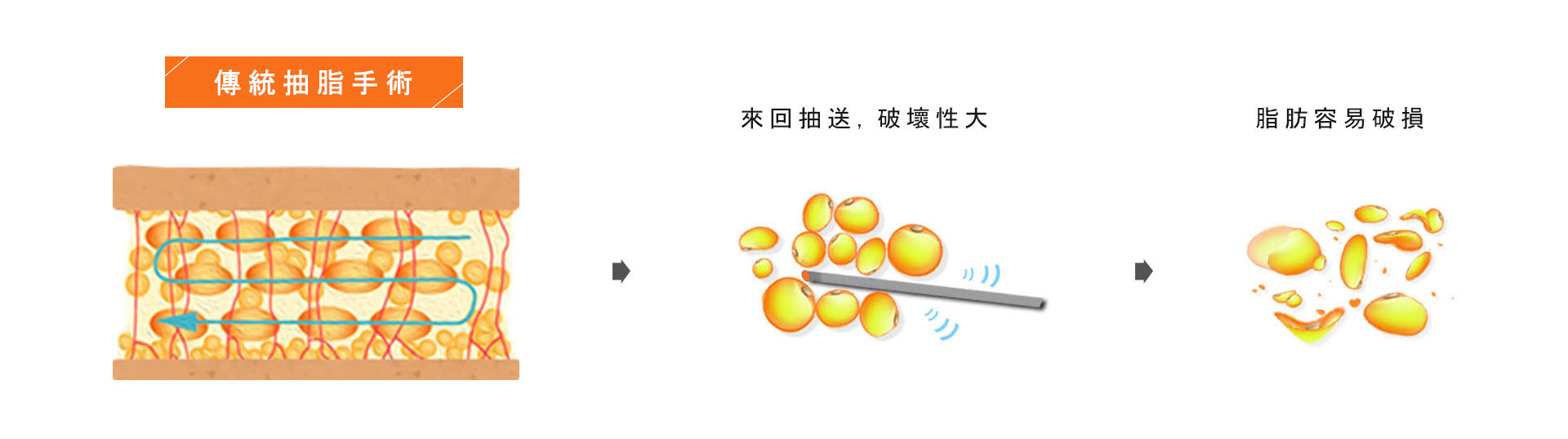 傳統抽脂手術 屬早期的抽脂技術,傳統抽脂分為乾式抽脂與濕式抽脂,其方法是將抽脂的矽管插入皮下組織的脂肪層中,來回的搓動,打散脂肪團塊,再將其刮出,但手術過程中會因為醫師的力量控制不當,而導致血管神經與組織的傷害,疼痛感較大,出血量多,恢復期會較長。