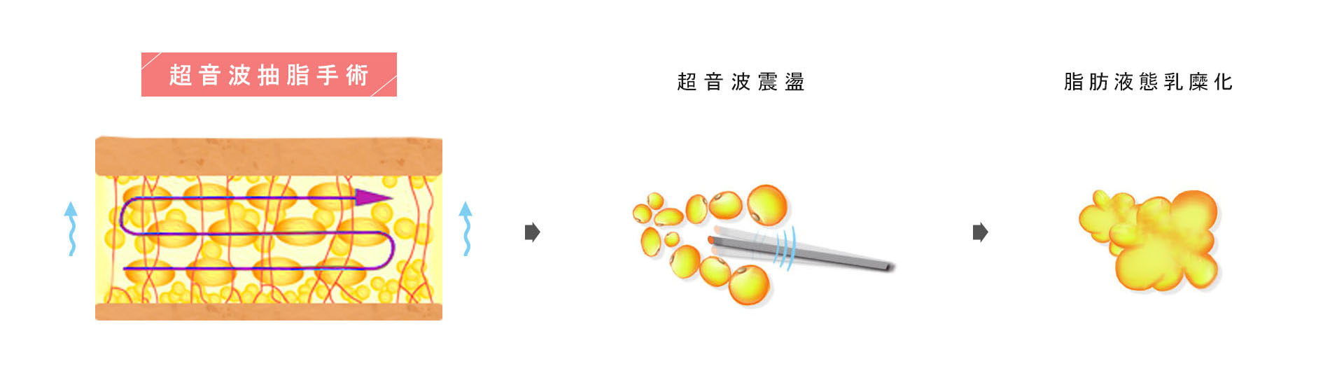 超音波抽脂手術是利用超音波快速的震盪產生熱能來溶解脂肪,再將溶解、乳糜化的脂肪以負壓吸出,屬於非入侵式的抽脂方式,能確保不會破壞血管神經及組織,疼痛感低,出血量少,消腫快恢復期短,術後幾乎無疤痕