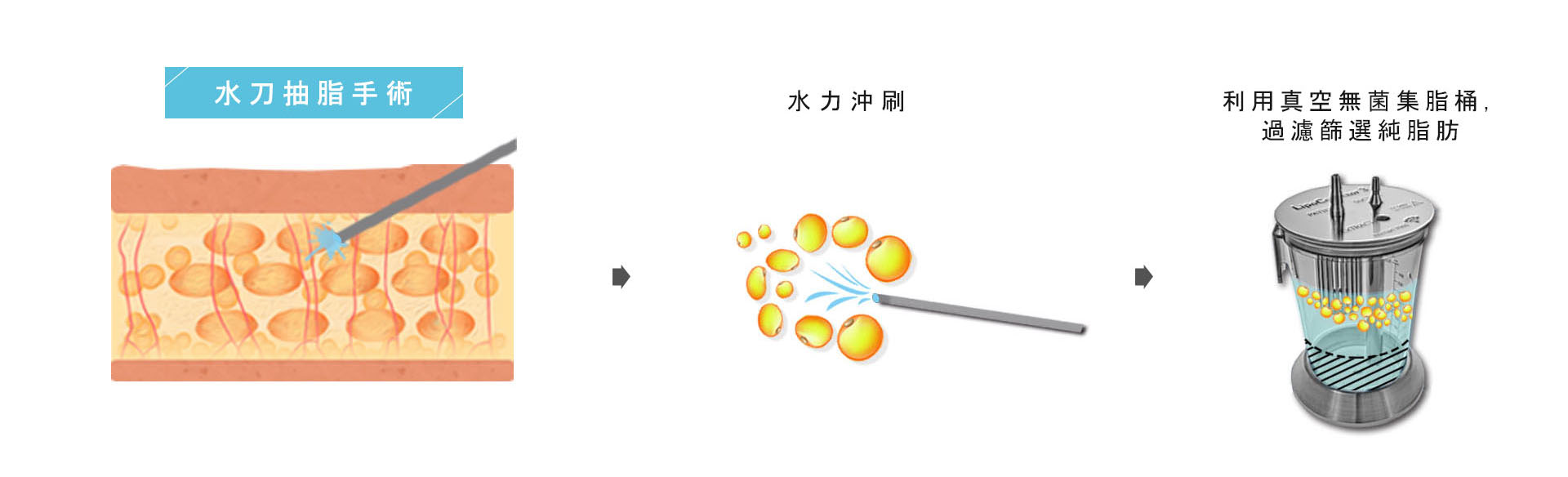 水刀抽脂手術是利用高壓水柱,搭配專用的配方水,用水的壓力沖刷脂肪組織,分離脂肪細胞,在將軟化後的液化脂肪以負壓吸出,是溫和的抽脂方式,對組織的傷害性低,可有效避免傷害到血管神經創傷及熱傷害,疼痛感低,腫脹程度小,恢復期快,以此方法吸出的脂肪,其存活率較高,適合用在自體脂肪移植手術上。