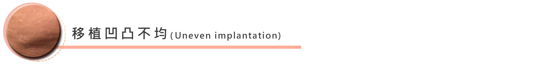 移植凹凸不均:由於脂肪和玻尿酸相比,它是非均質的物質,因此術後脂肪吸收程度不等,可能會造成移植區域凹凸不平的現象,可在凹陷部位再次注射脂肪顆粒,以使術後效果更好。