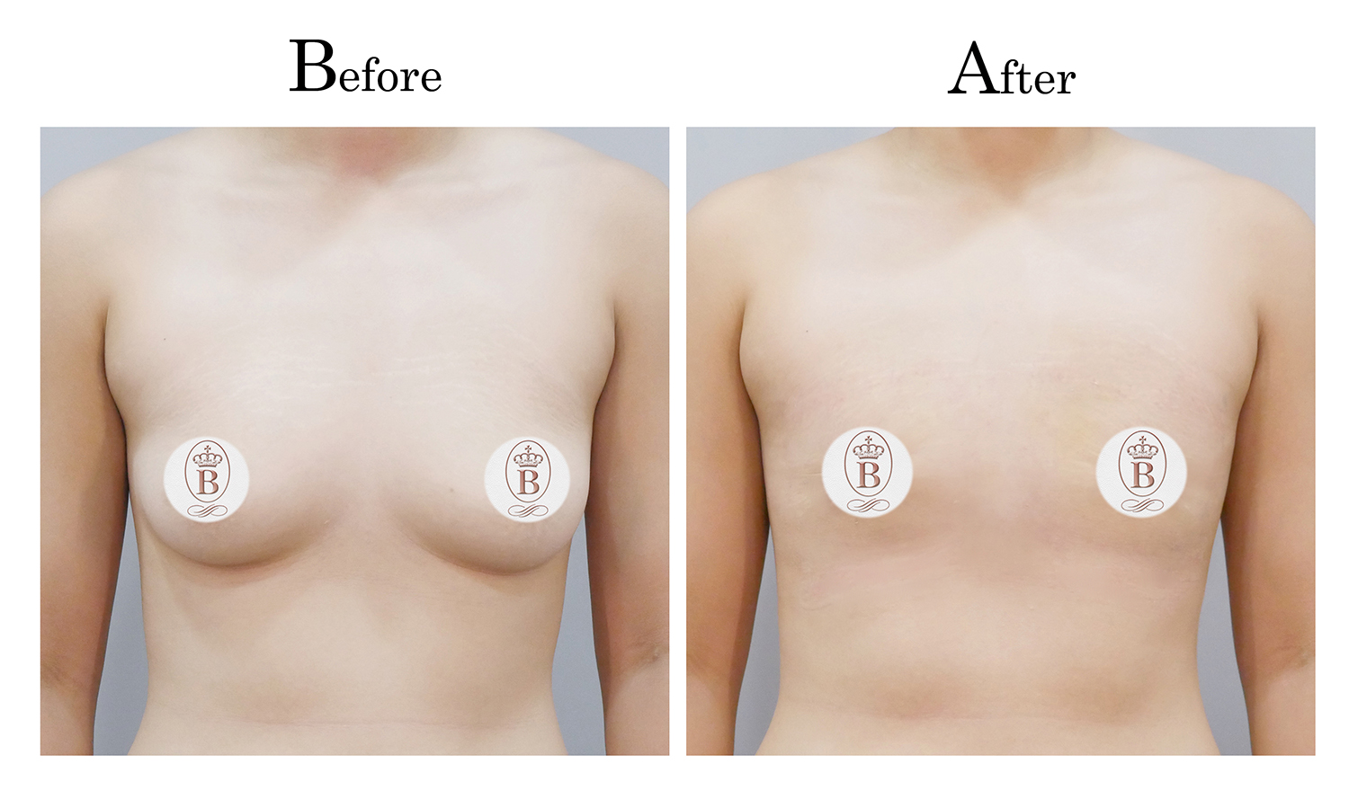縮胸平胸手術術前術後比較