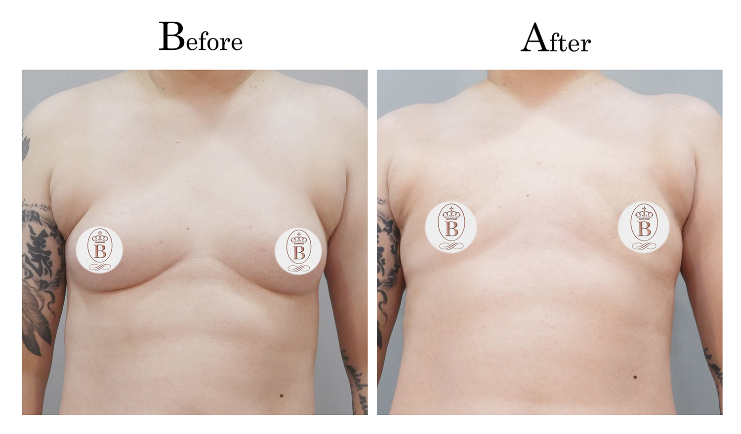 平胸術前術後比較