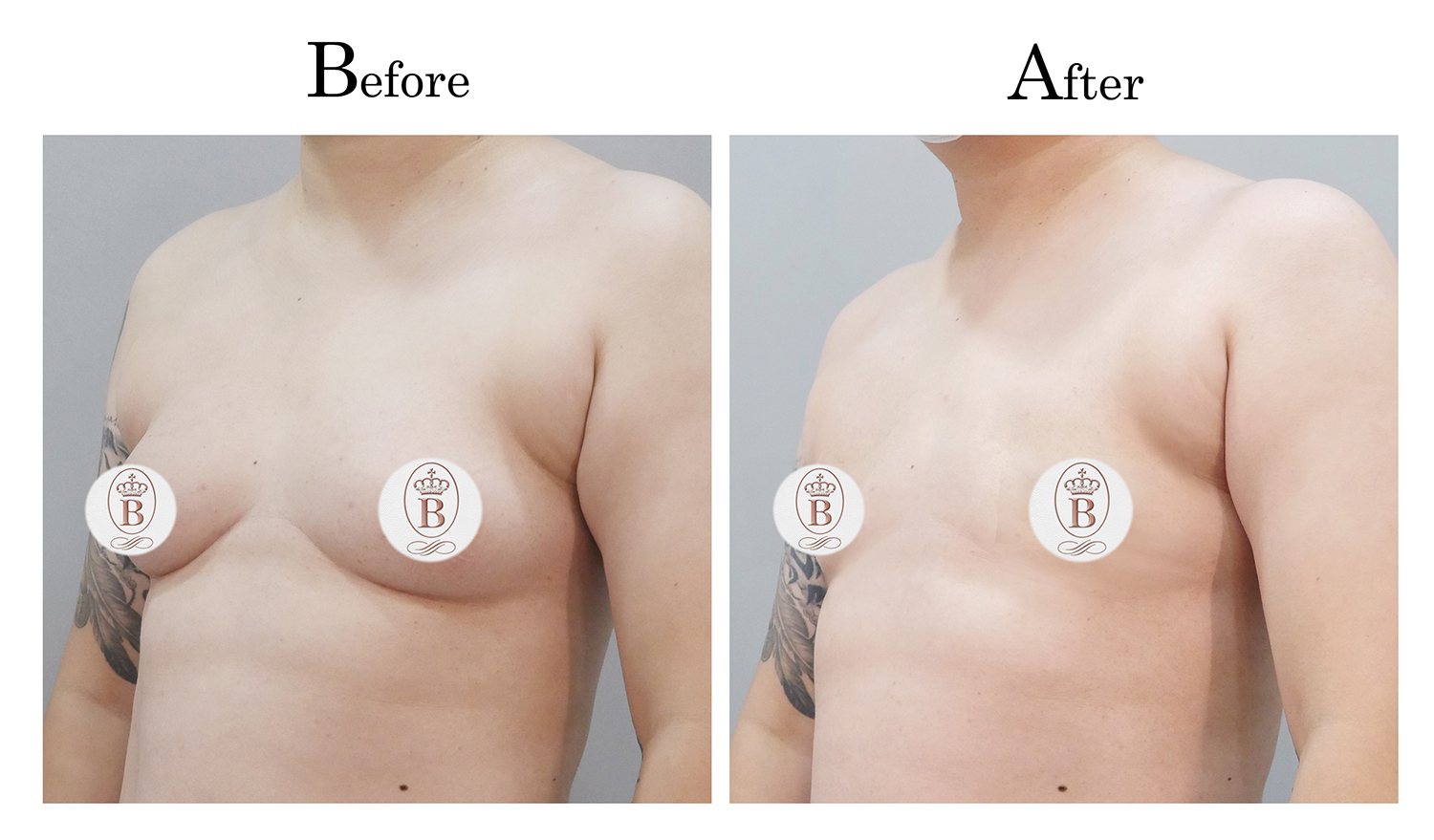 平胸術前術後比較