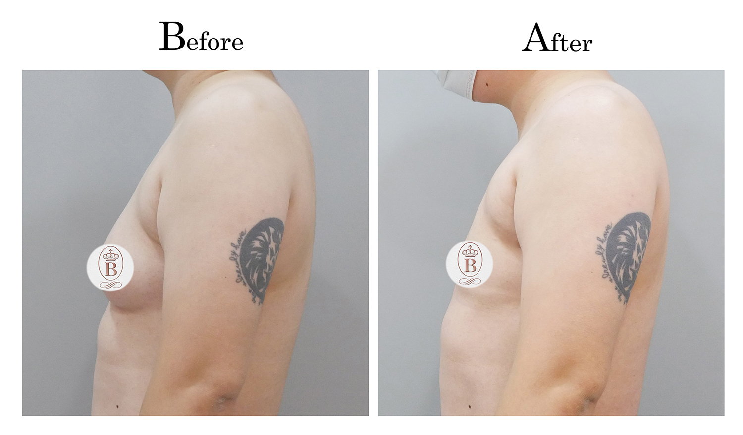 平胸術前術後比較