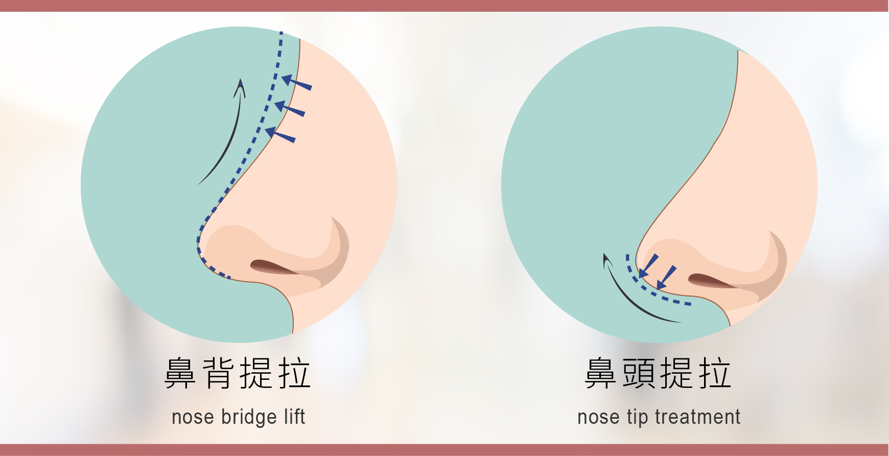 鼻修复案例：拯救被线雕做坏了的鼻子！ - 知乎