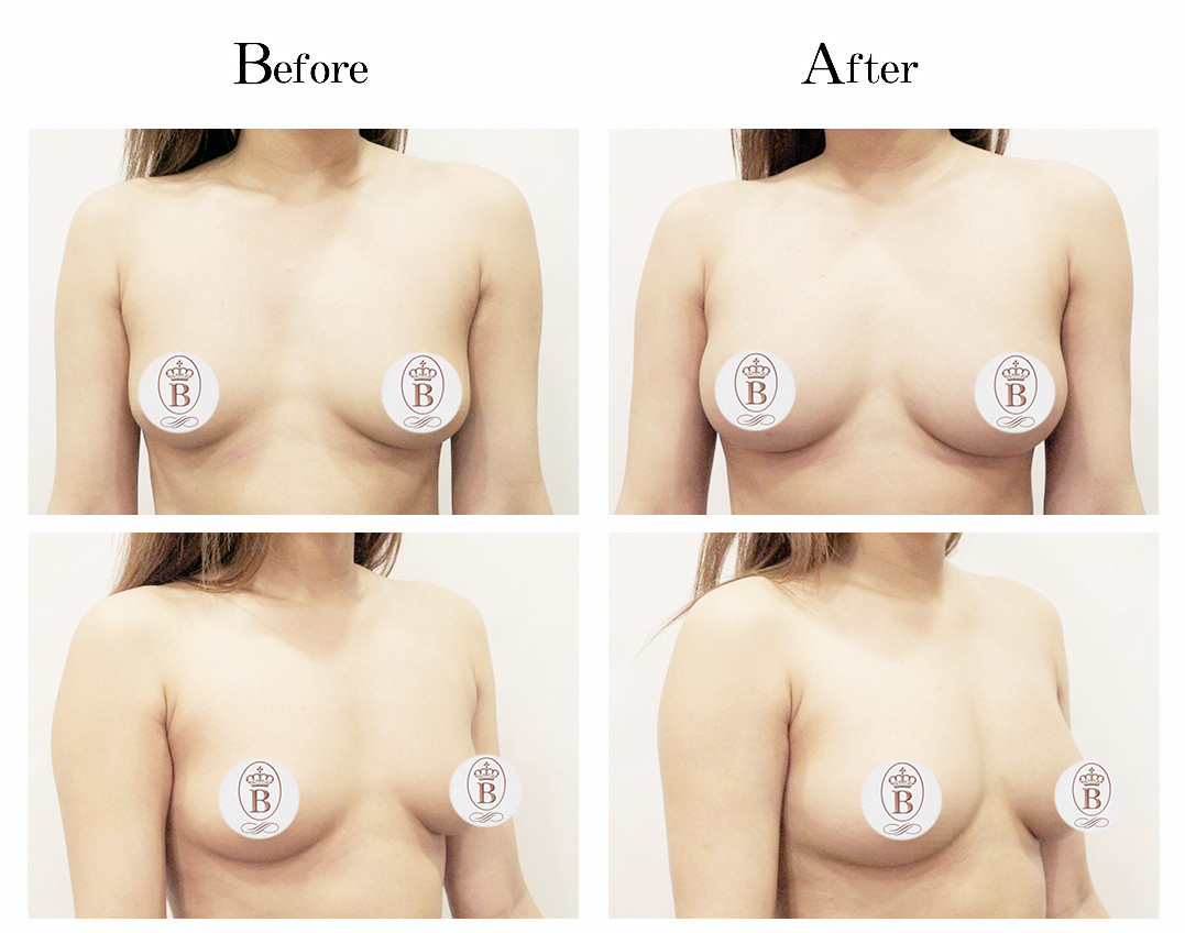 台中自體脂肪隆乳,自體脂肪隆乳費用,自體脂肪隆乳價格,自體脂肪隆乳推薦,自體脂肪隆乳權威,自體脂肪隆乳林仲樵醫師