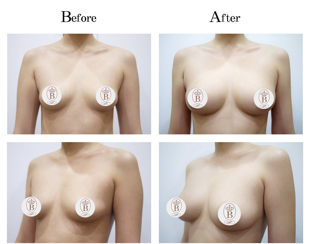 台中自體脂肪隆乳,自體脂肪隆乳費用,自體脂肪隆乳價格,自體脂肪隆乳推薦,自體脂肪隆乳權威,自體脂肪隆乳林仲樵醫師