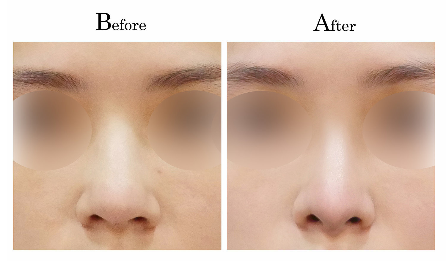 台中隆鼻,台中鼻整形,客製化隆鼻001