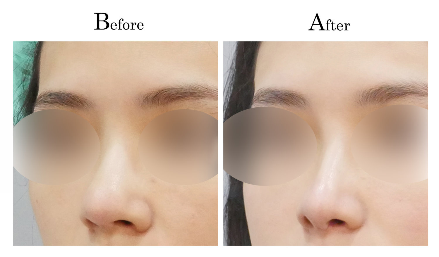 台中隆鼻,台中鼻整形,客製化隆鼻002