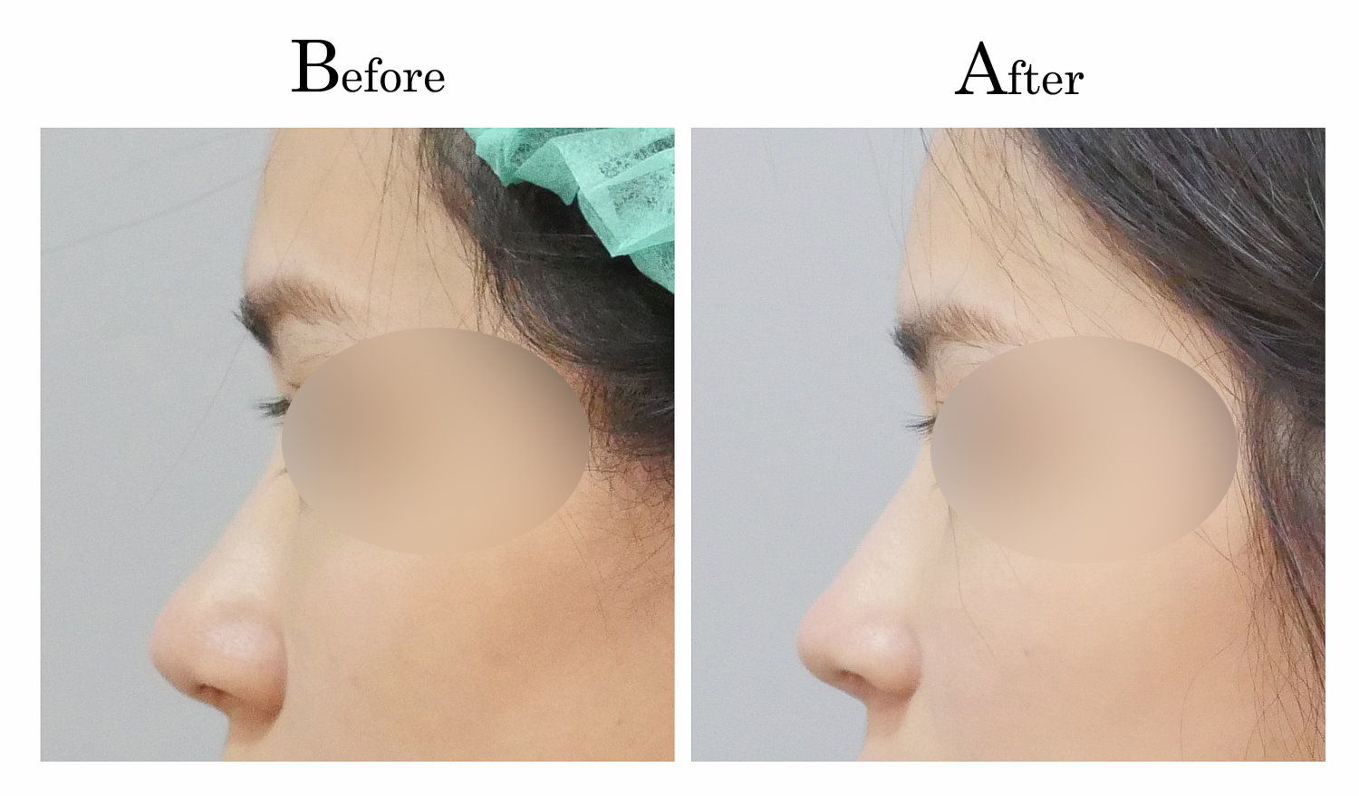 台中隆鼻,台中鼻整形,客製化隆鼻003