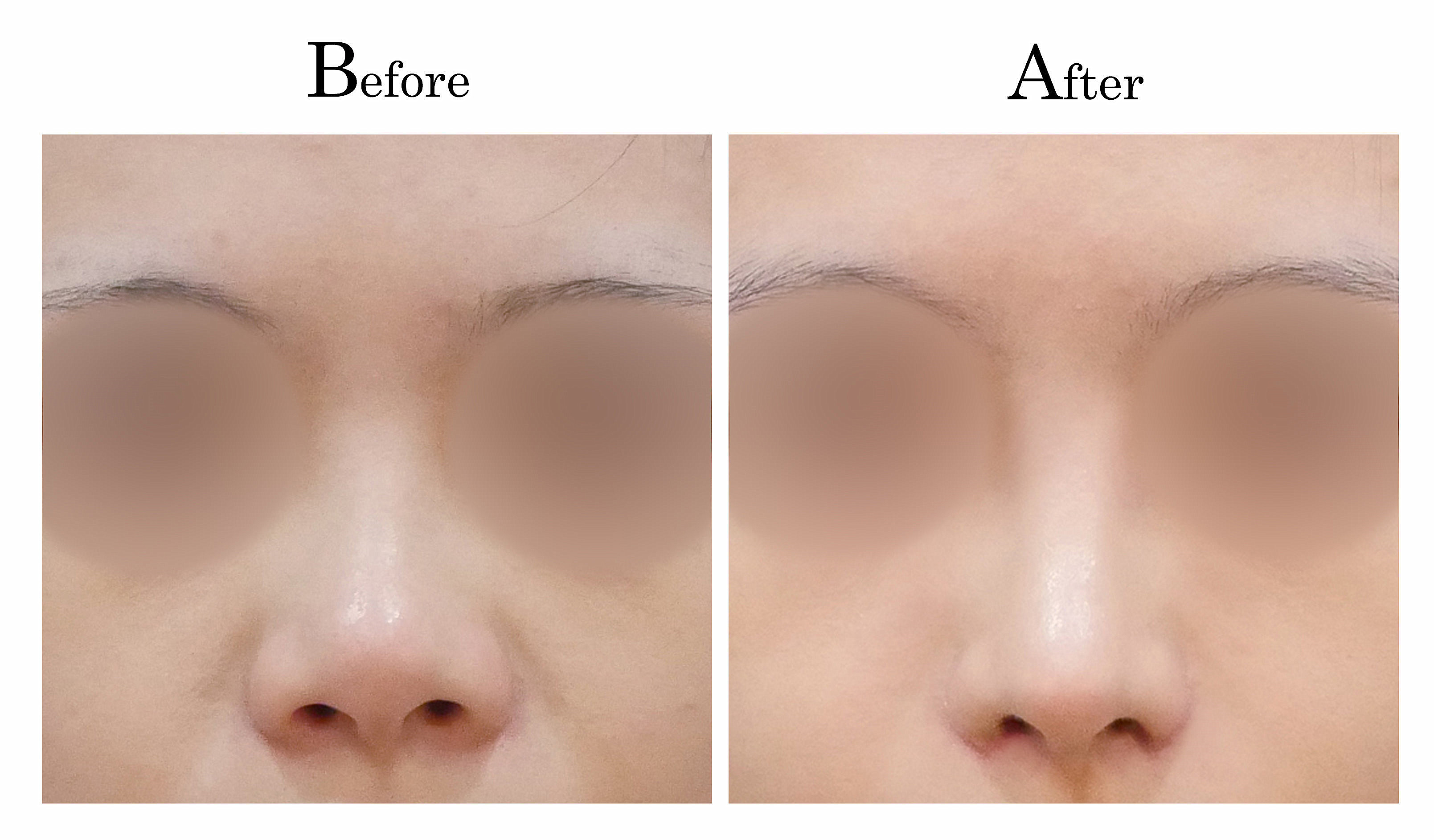 台中隆鼻,台中鼻整形,客製化隆鼻2_001