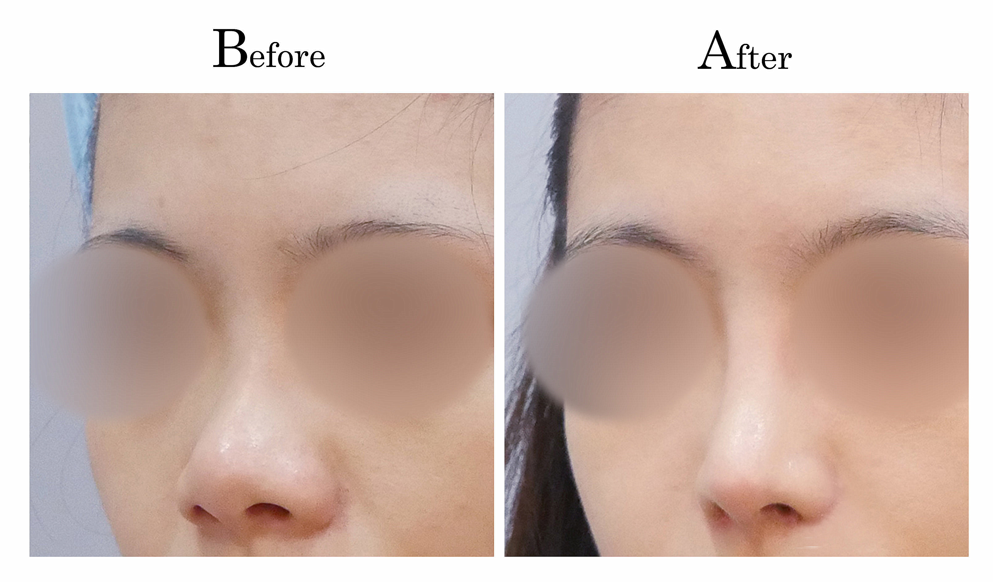 台中隆鼻,台中鼻整形,客製化隆鼻2_002