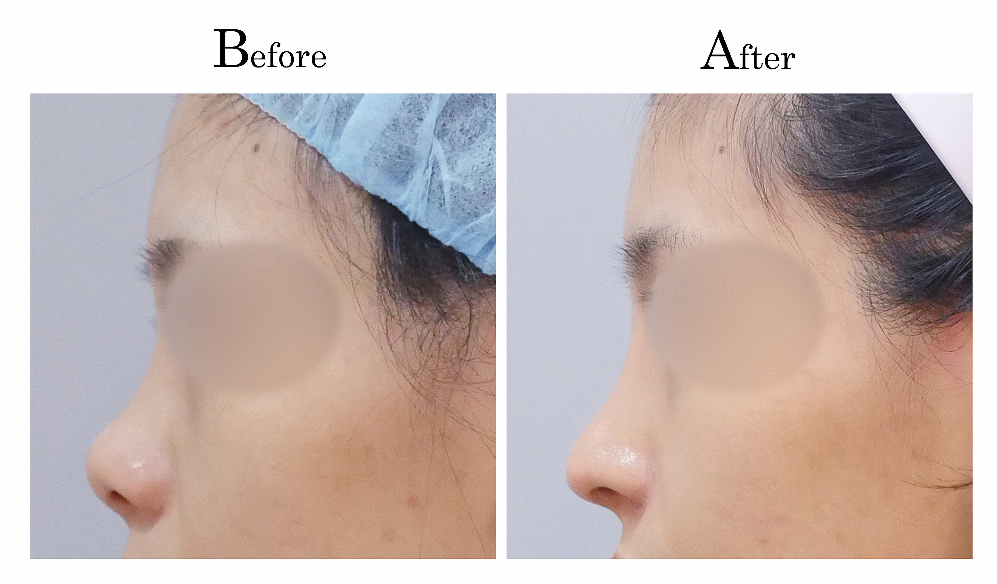 台中隆鼻,台中鼻整形,客製化隆鼻2_003