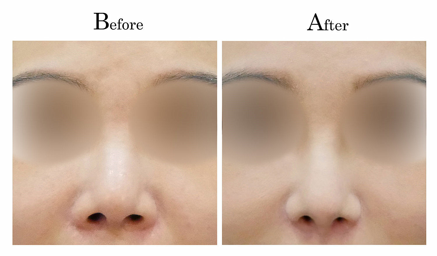 台中隆鼻,台中鼻整形,客製化隆鼻3_001