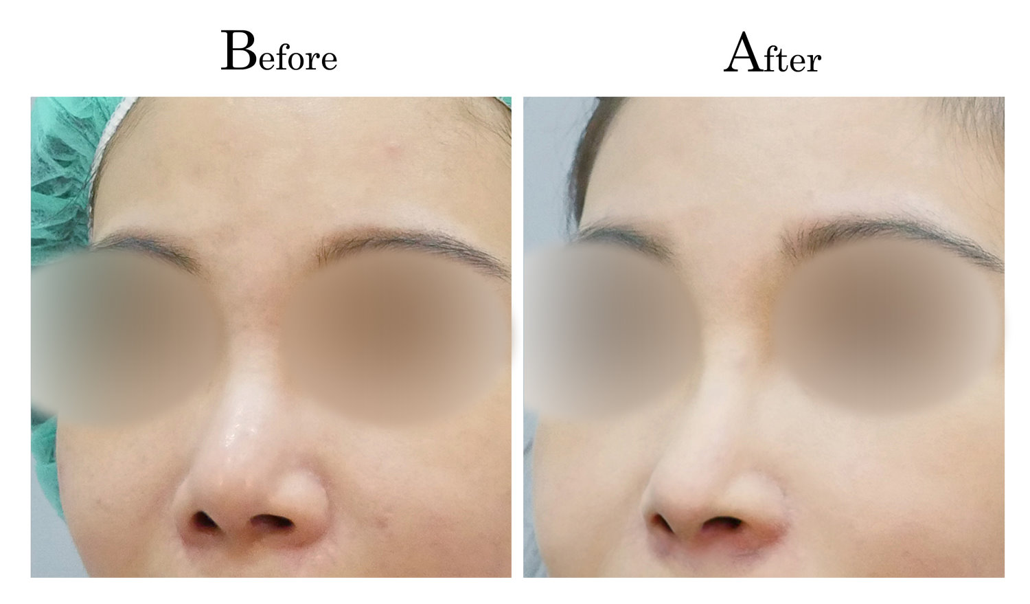 台中隆鼻,台中鼻整形,客製化隆鼻3_002