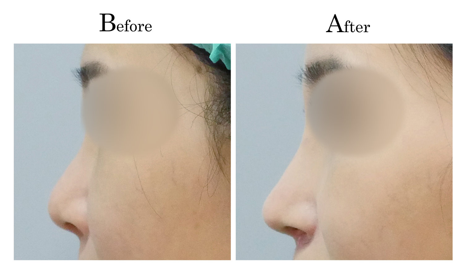 台中隆鼻,台中鼻整形,客製化隆鼻3_003