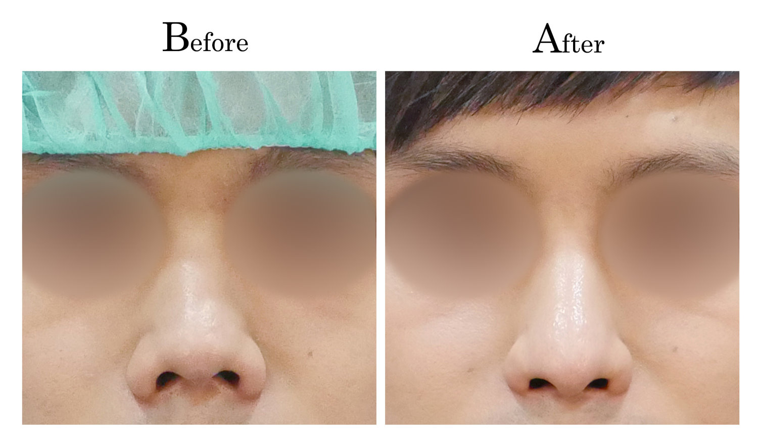 台中隆鼻,台中鼻整形,客製化隆鼻,男生男性隆鼻1_001