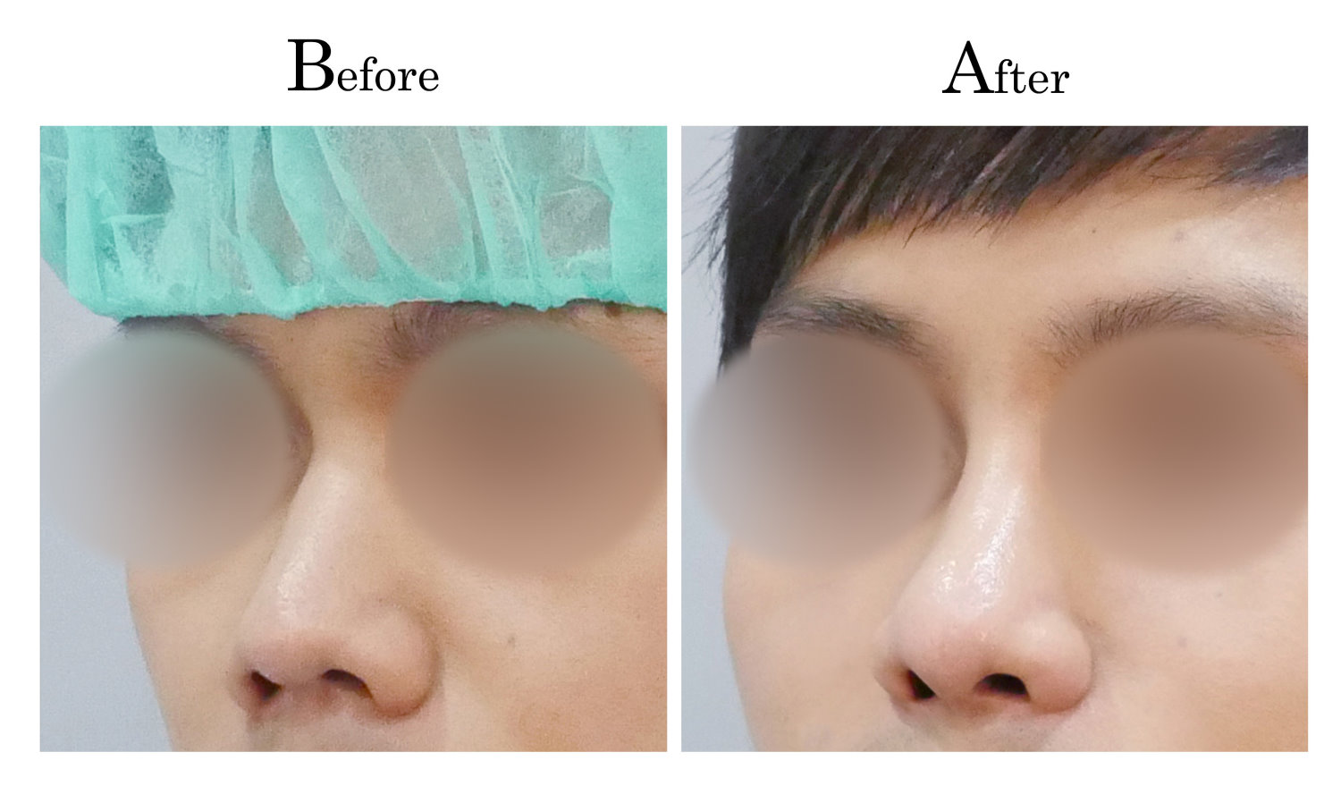 台中隆鼻,台中鼻整形,客製化隆鼻,男生男性隆鼻1_002