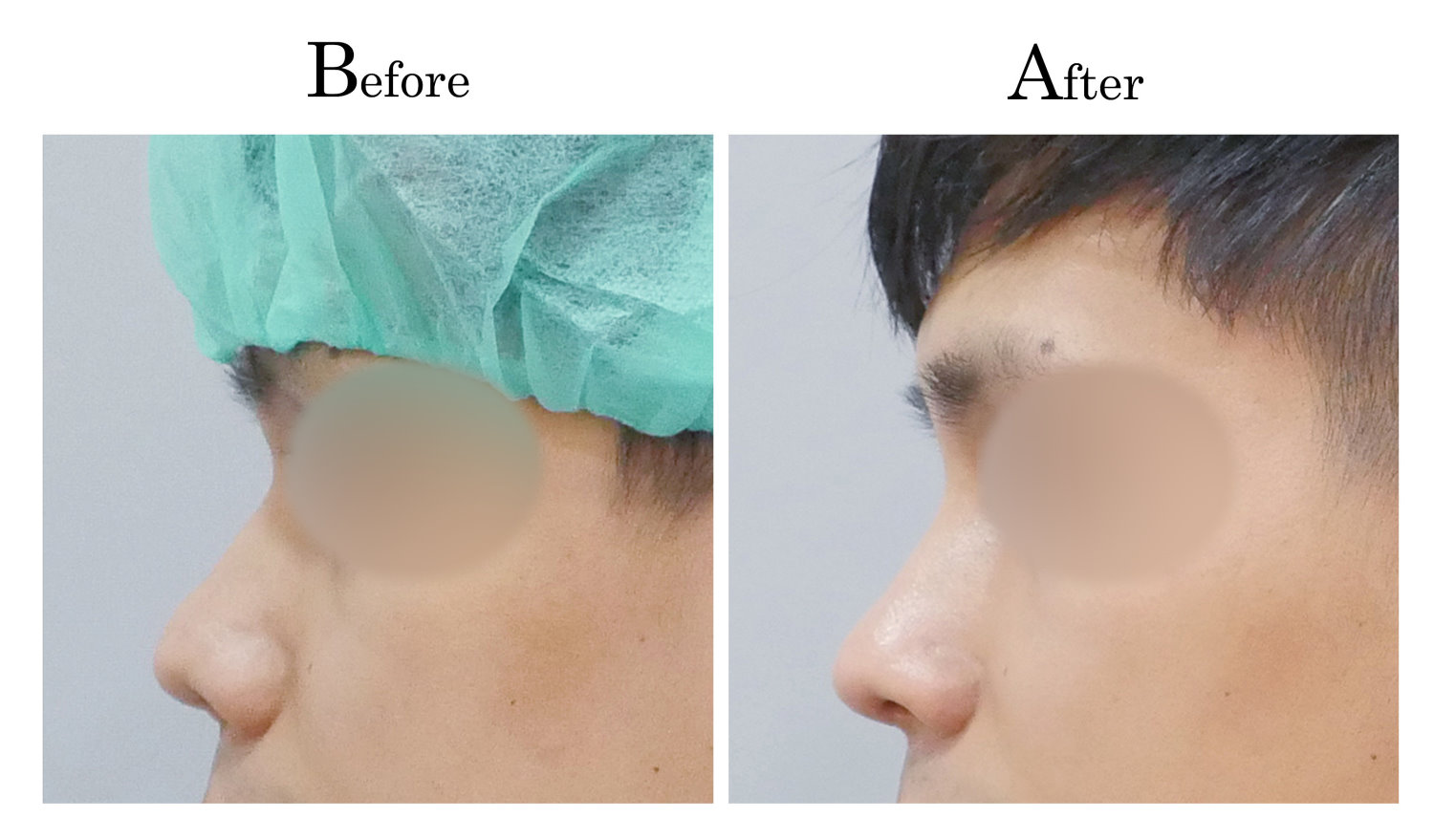 台中隆鼻,台中鼻整形,客製化隆鼻,男生男性隆鼻1_003