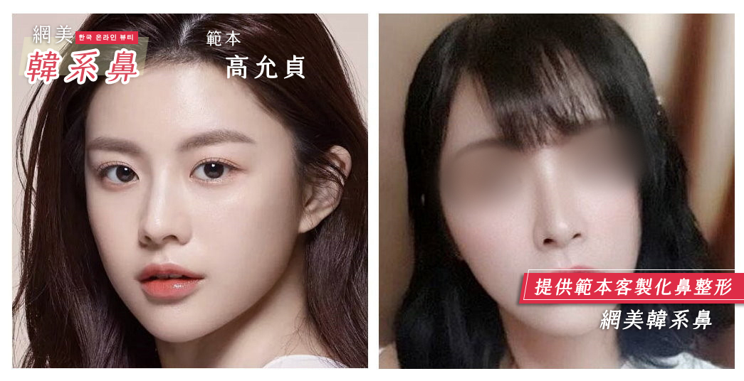 隆鼻手術,朱立箴醫師隆鼻,韓式隆鼻,高允貞韓系鼻型