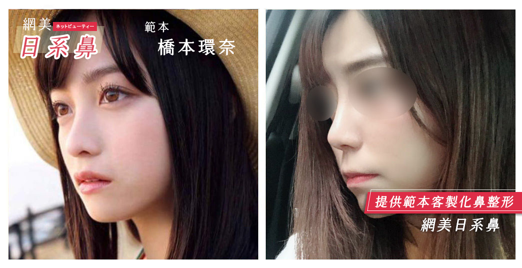 隆鼻手術,朱立箴醫師隆鼻,日式隆鼻,橋本環奈鼻型