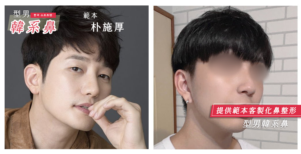 隆鼻手術,朱立箴醫師隆鼻,韓式型男隆鼻,朴施厚鼻型