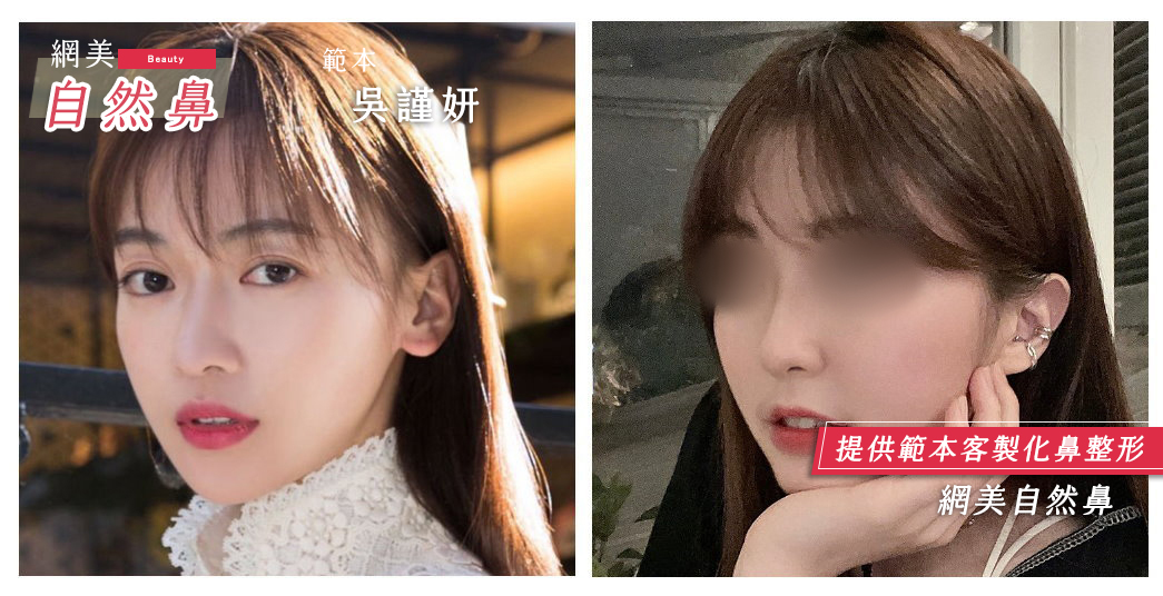 隆鼻手術,朱立箴醫師隆鼻,網美自然系隆鼻,吳謹言鼻型