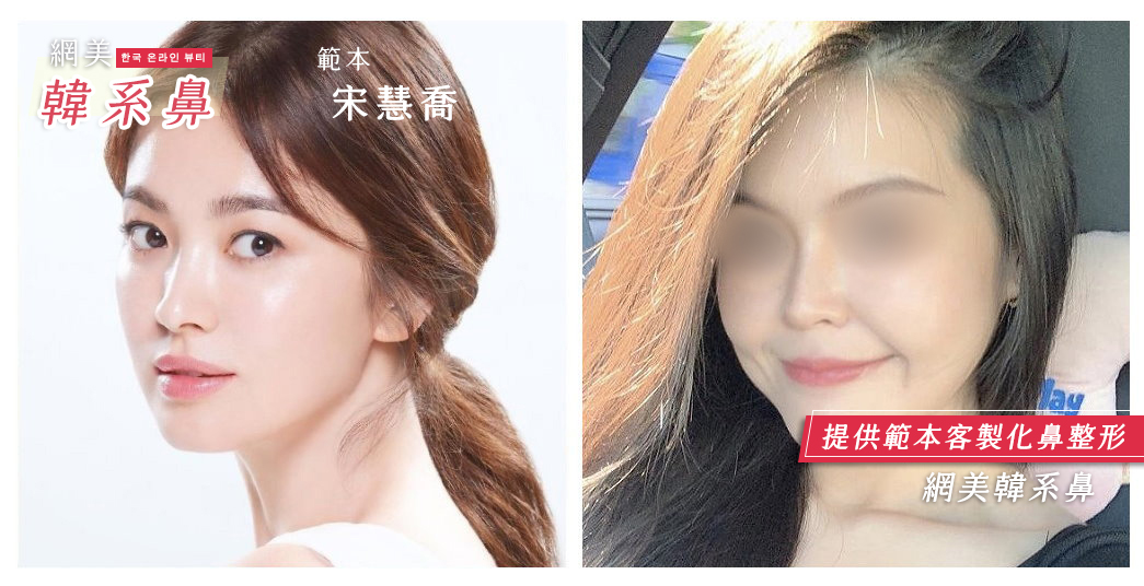 隆鼻手術,朱立箴醫師隆鼻,韓式隆鼻,宋慧喬鼻型