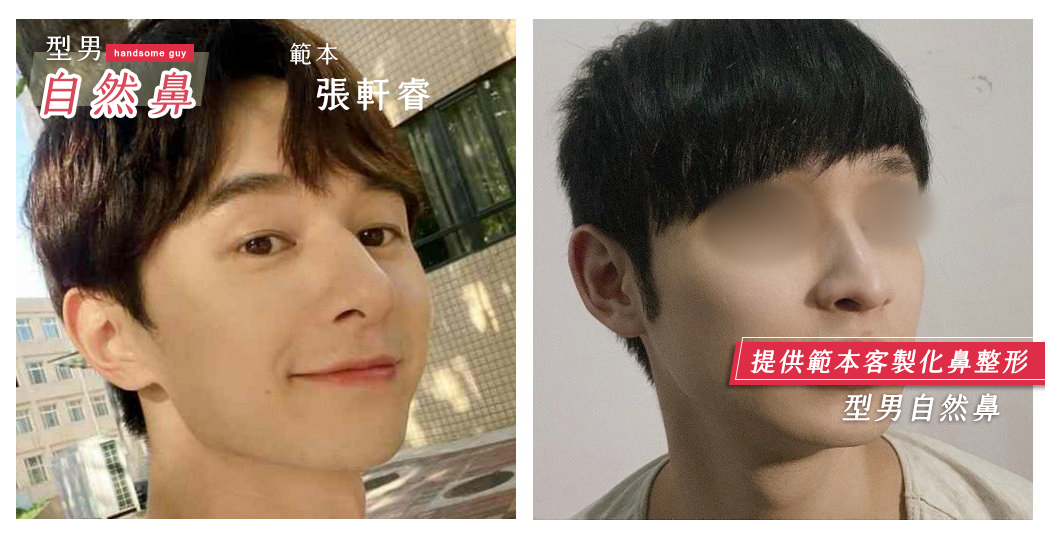隆鼻手術,朱立箴醫師隆鼻,韓式型男隆鼻,張軒睿鼻型