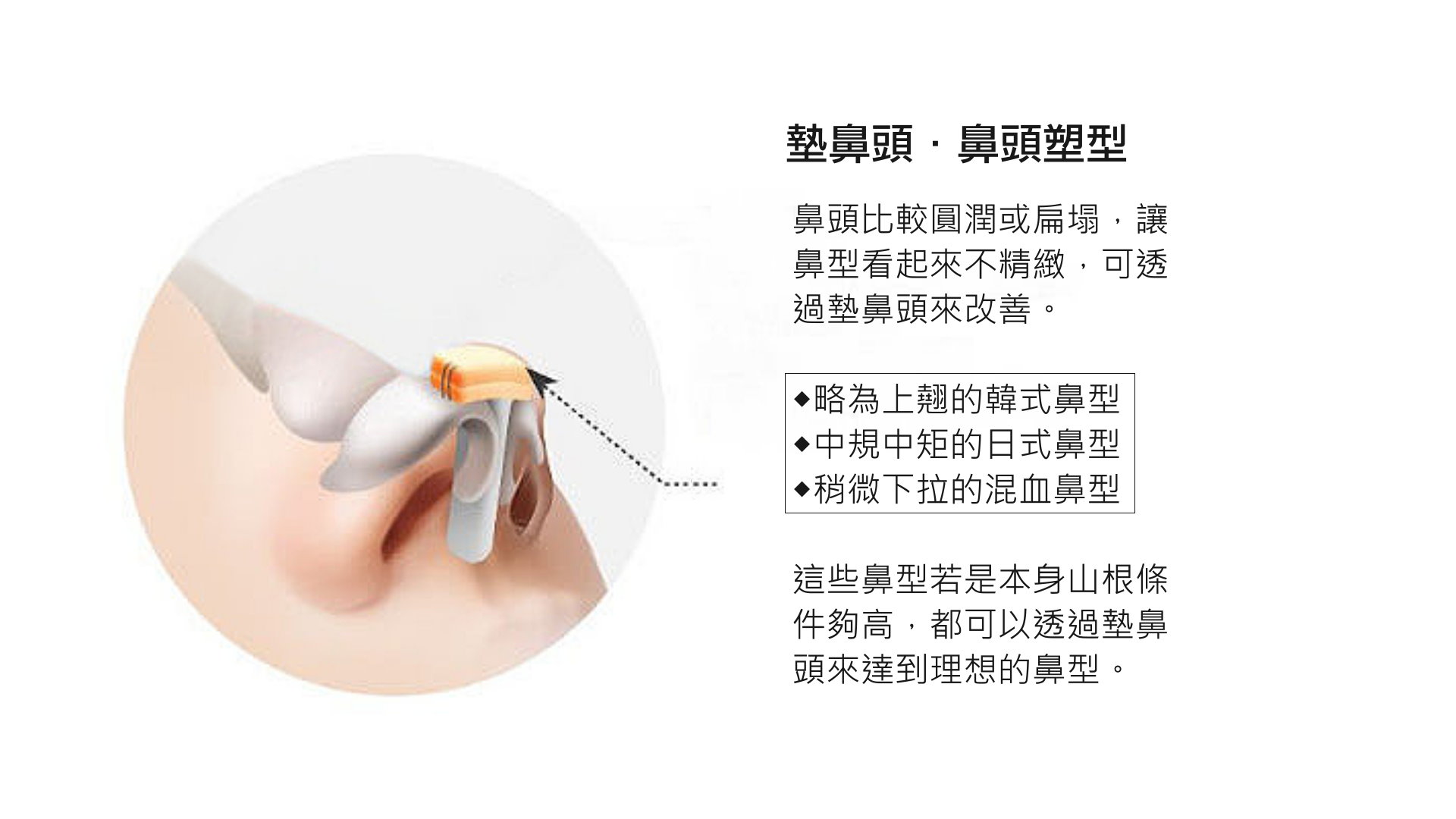 3D列印墊鼻頭手術