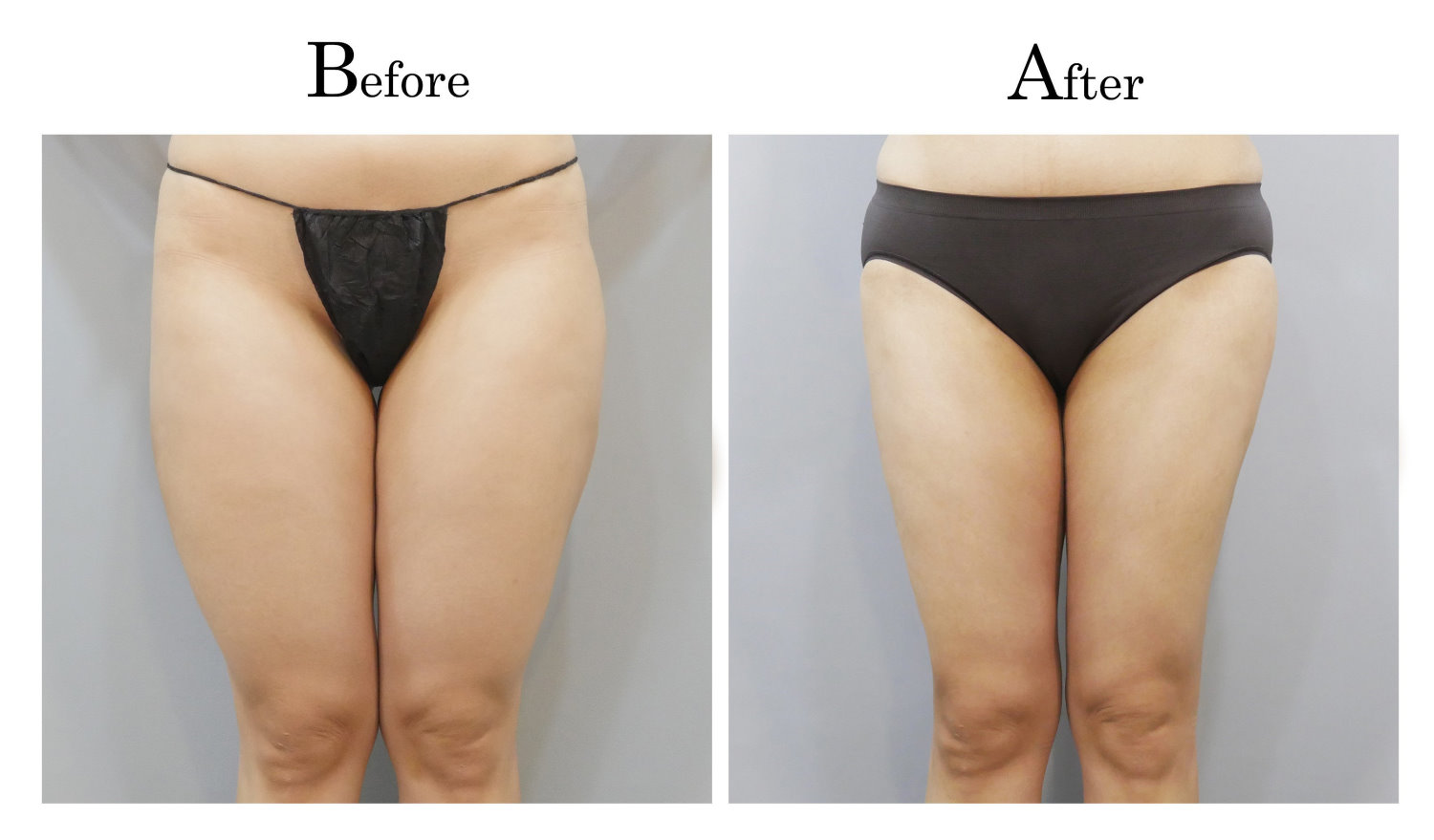 台中大腿抽脂手術,大腿環抽,邱智弘抽脂手術,Vaser威塑抽脂2_01