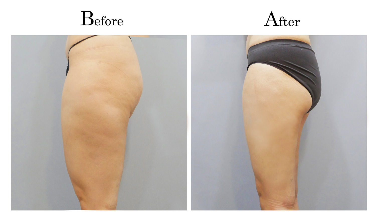 台中大腿抽脂手術,大腿環抽,邱智弘抽脂手術,Vaser威塑抽脂2_03