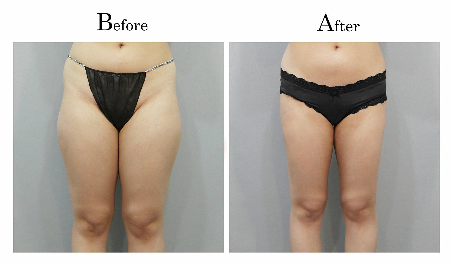 台中大腿抽脂手術,大腿環抽,邱智弘抽脂手術,Vaser威塑抽脂1_01